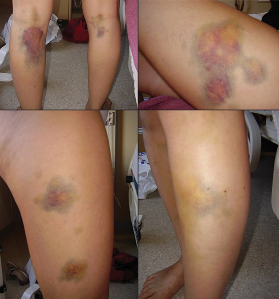 Name:  Lonomia-caterpilar-poison1.jpg
Views: 602
Size:  175.4 KB